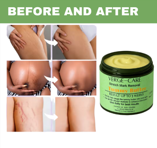 Strecth Mark oil and Tummy Butter 1oz 30ml